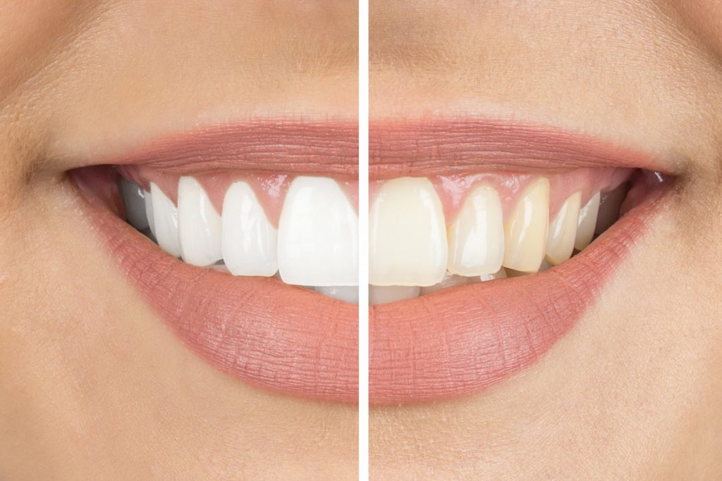 Get-White-Teeth